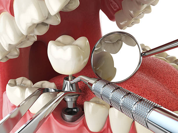 Best Emergency Dental Care for Broken or Chipped Teeth in Riverside, CT